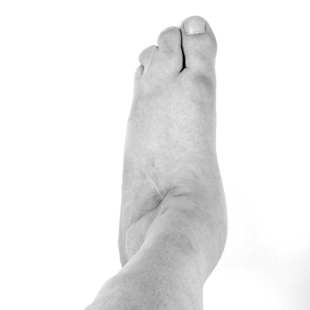 Exhibition D FORMED My Left Foot Disability Arts Online